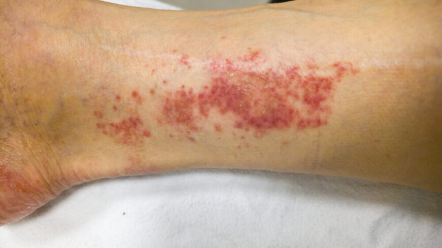 Palpabel purpura på underbenet – ett hudfynd som kan ses vid kärlinflammation, till exempel vid granulomatös polyangit. (GPA) Foto: Getty Images