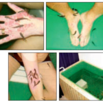 Kan psoriasis lindras av sugfiskar?