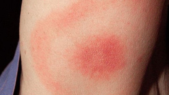 Borrelia – symtom och förebyggande åtgärder
