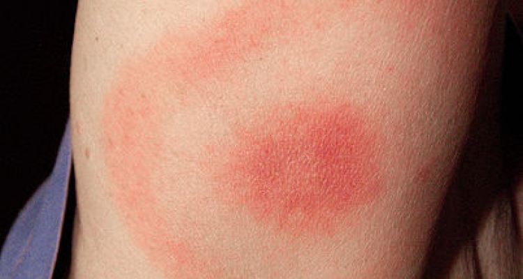 Borrelia – symtom och förebyggande åtgärder