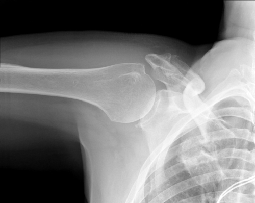  Röntgenbild som visar nyckelbensfraktur. Foto: Shutterstock