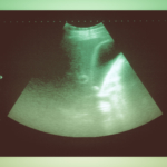 Gallsten: orsak symtom & behandling