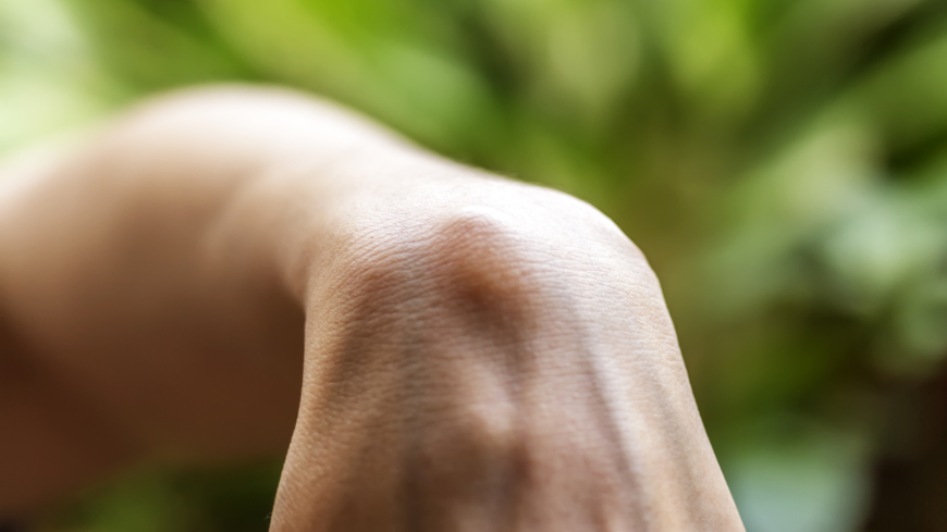  Senganglion visar sig ofta som en mjuk knöl på handleden eller handen. Foto: Shutterstock