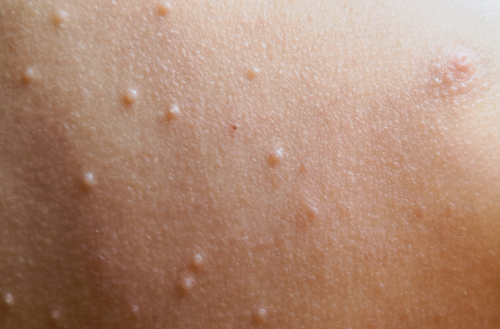 Mollusker hos barn: smitta, symtom och när behandling behövs