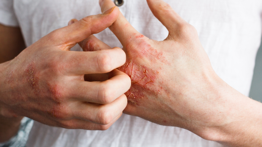 Psoriasis kan kännas besvärligt men det finns behandling. Foto: Shutterstock