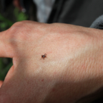 Borrelia: orsak, symtom & behandling