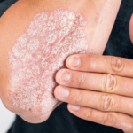 Webb-TV: Psoriasis