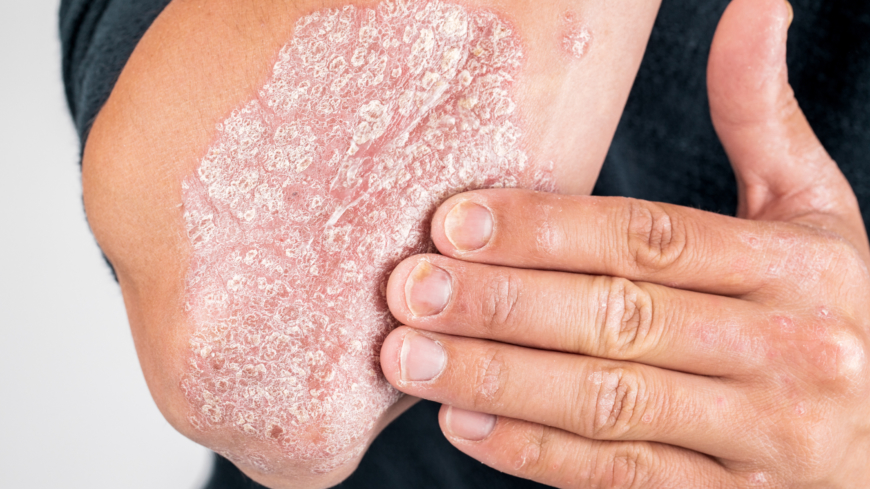 Webb-TV: Psoriasis