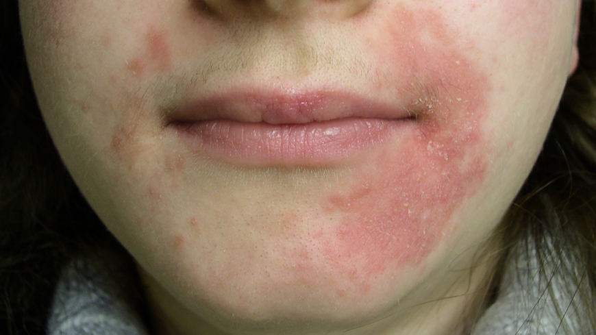 Orsakerna till perioral dermatit är inte klarlagda. Foto: Shutterstock