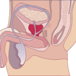 Prostatit – symtom, orsak och behandling