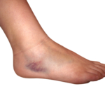 Stukad fot – orsak, symtom & behandling