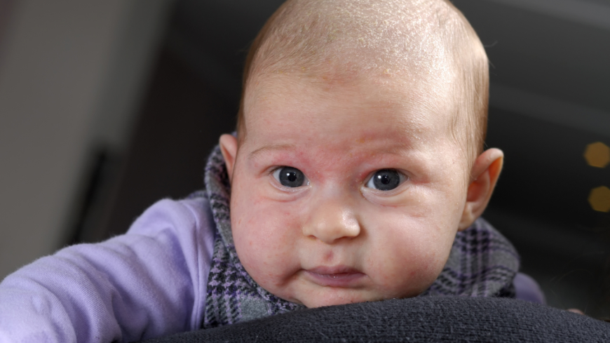 Webb-TV: Atopiskt eksem