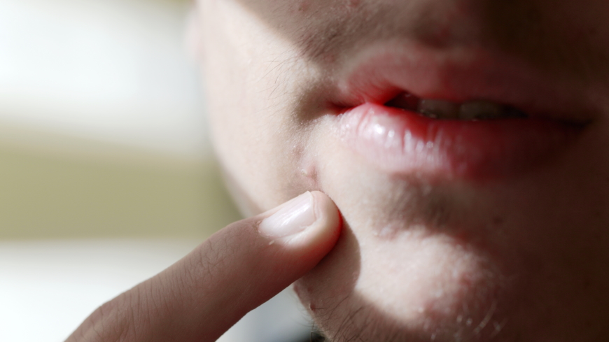 Oftast sitter akneutslagen i ansiktet, men ibland också på bröst eller rygg. De läker för det mesta utan att lämna ärr. Foto: Shutterstock