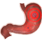 Webb-TV: Reflux – magsår