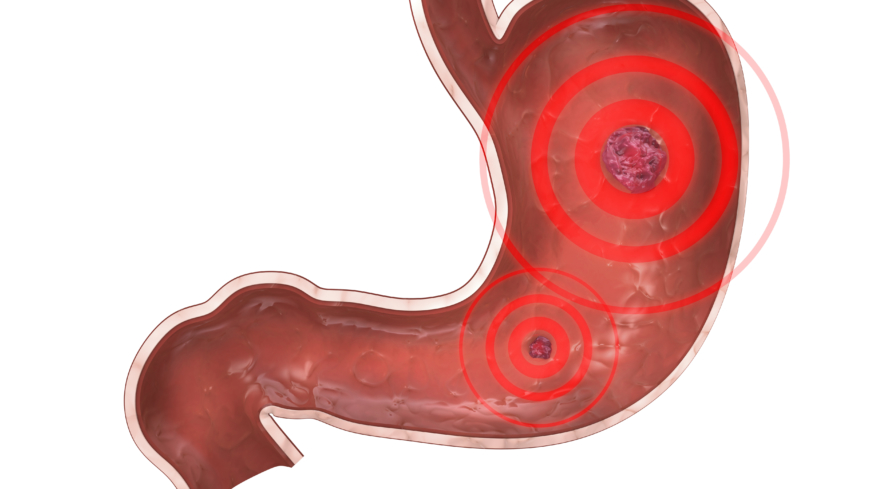 Webb-TV: Reflux – magsår