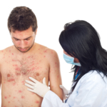 Fjällros, medaljongsjuka, pityriasis rosea