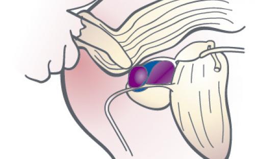 Blod i sädesvätskan (hematospermi)